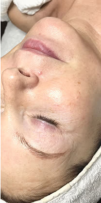 Haut nach der INFUZION® Behandlung