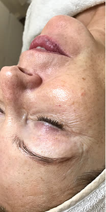 Haut vor der INFUZION® Behandlung